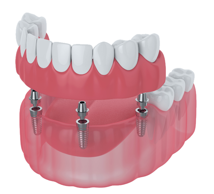 All-on-4 diagram: a full arch of fixed teeth supported by four dental implants placed in the jaw