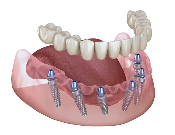 Fixed full-arch dental implants, All-on-4