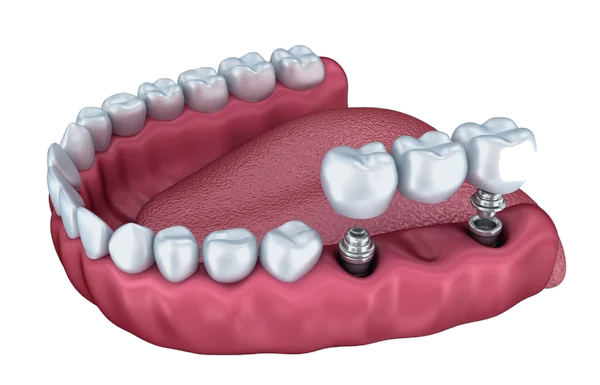 Implant-supported bridge replacing multiple teeth