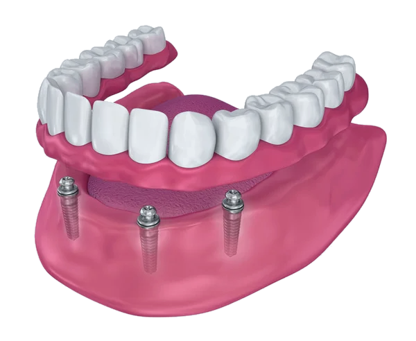 Snap-on denture stabilized by dental implants