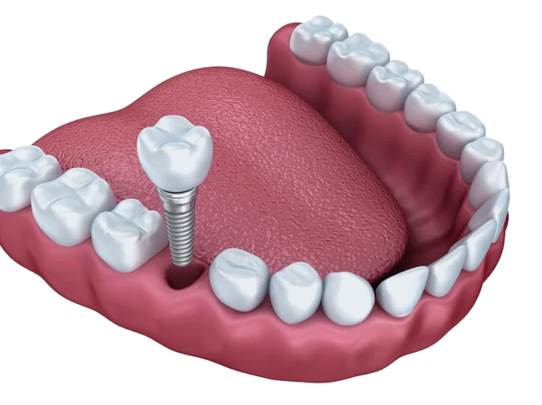Single tooth dental implant with crown