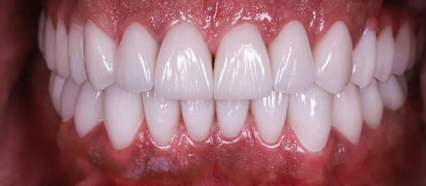 After: porcelain veneers by Dr.&nbsp;Mattschei, upper and lower teeth