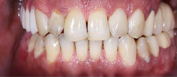 Before: worn, discolored and uneven teeth prior to porcelain veneers