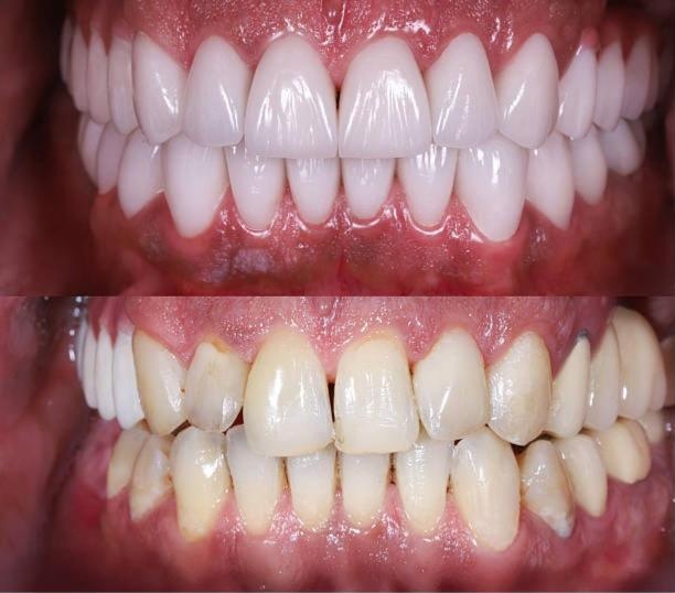Porcelain veneers case by Dr. Mattschei: after (top) and before (bottom)